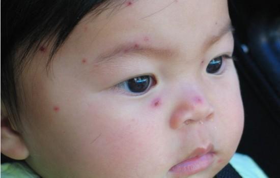 水痘可以吃小瓜嘛